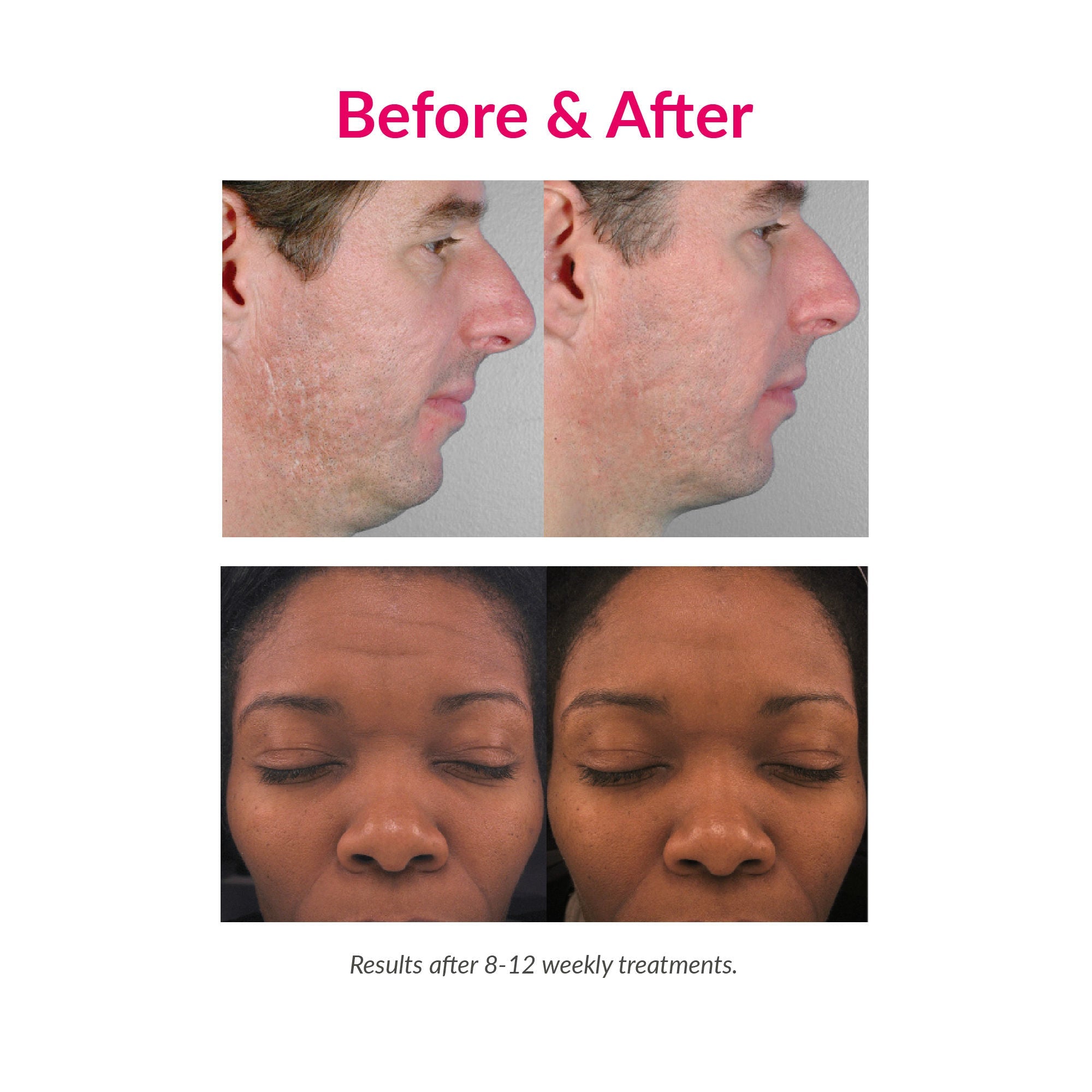 Personal Microderm Pro