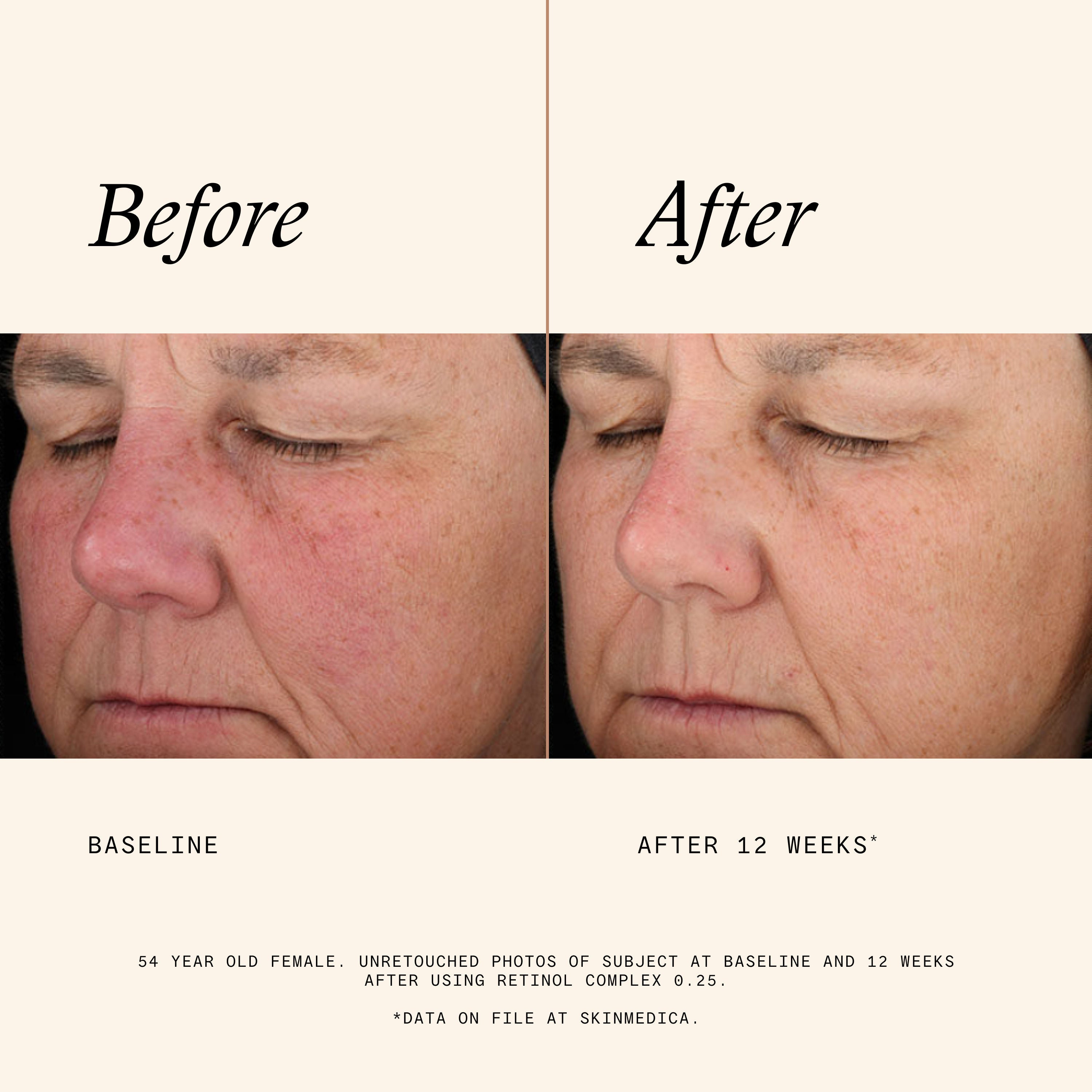 Retinol Complex 0.25