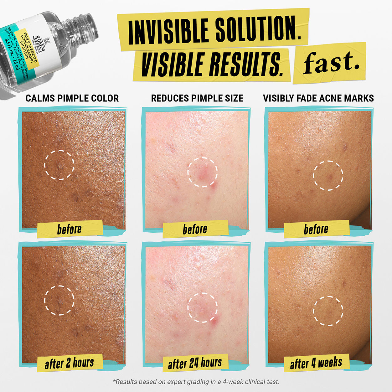 Truly Targeted Acne-Clearing Solution