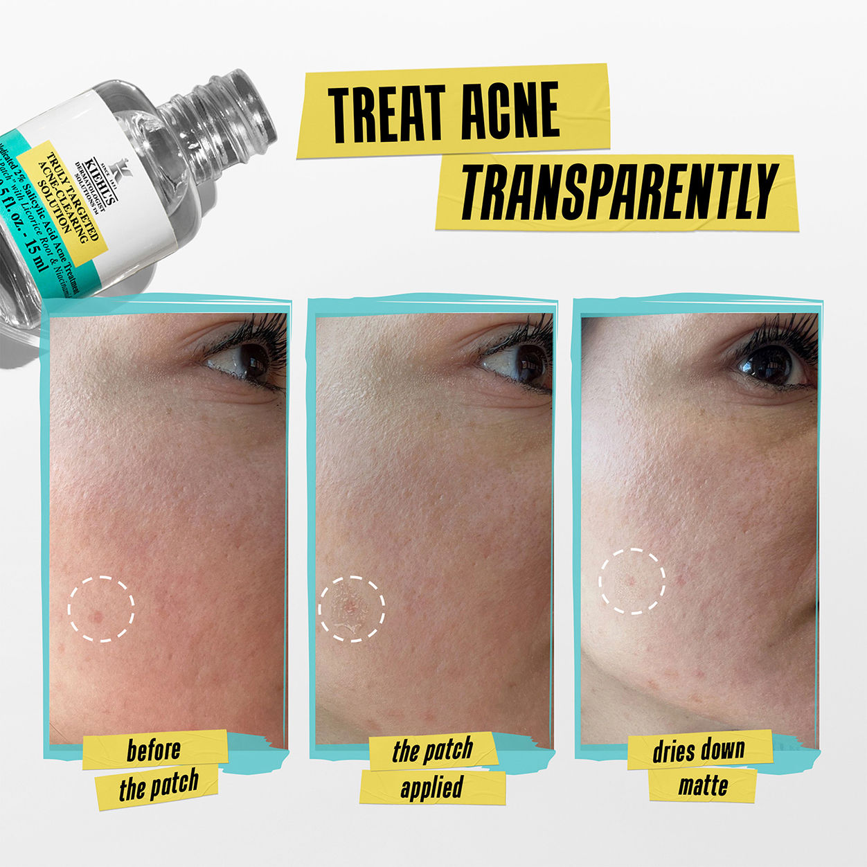 Truly Targeted Acne-Clearing Solution