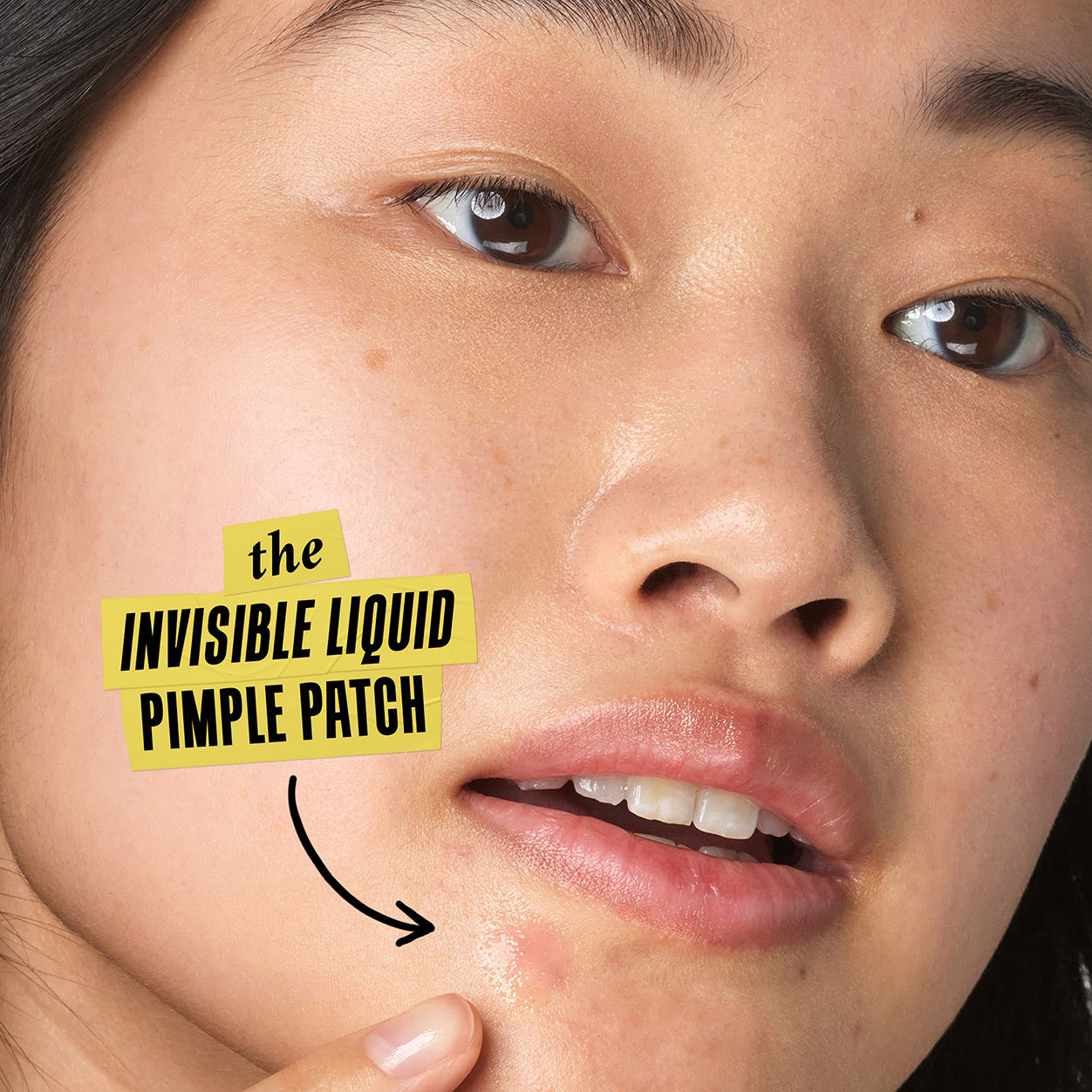 Truly Targeted Acne-Clearing Solution