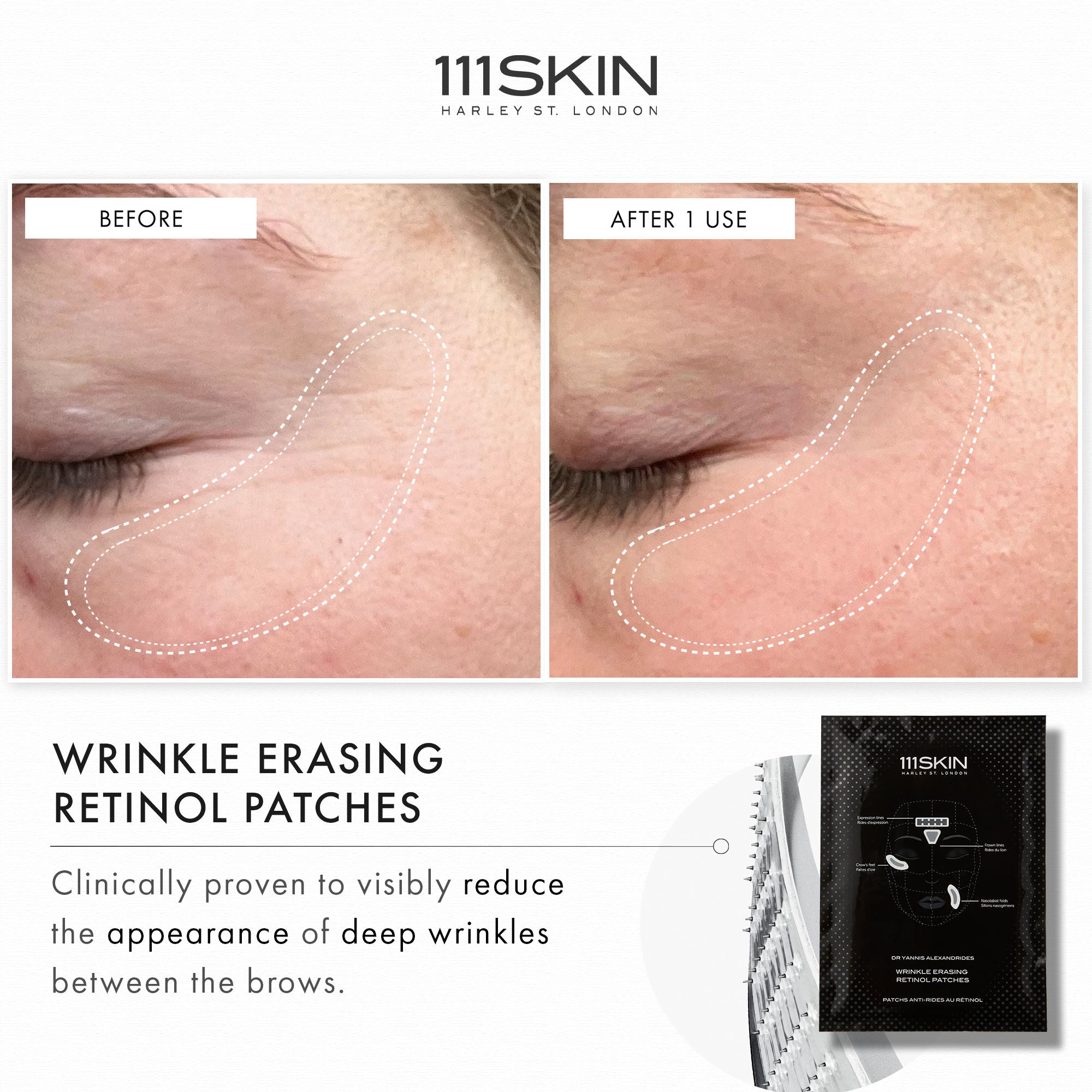Wrinkle Erasing Retinol Patches