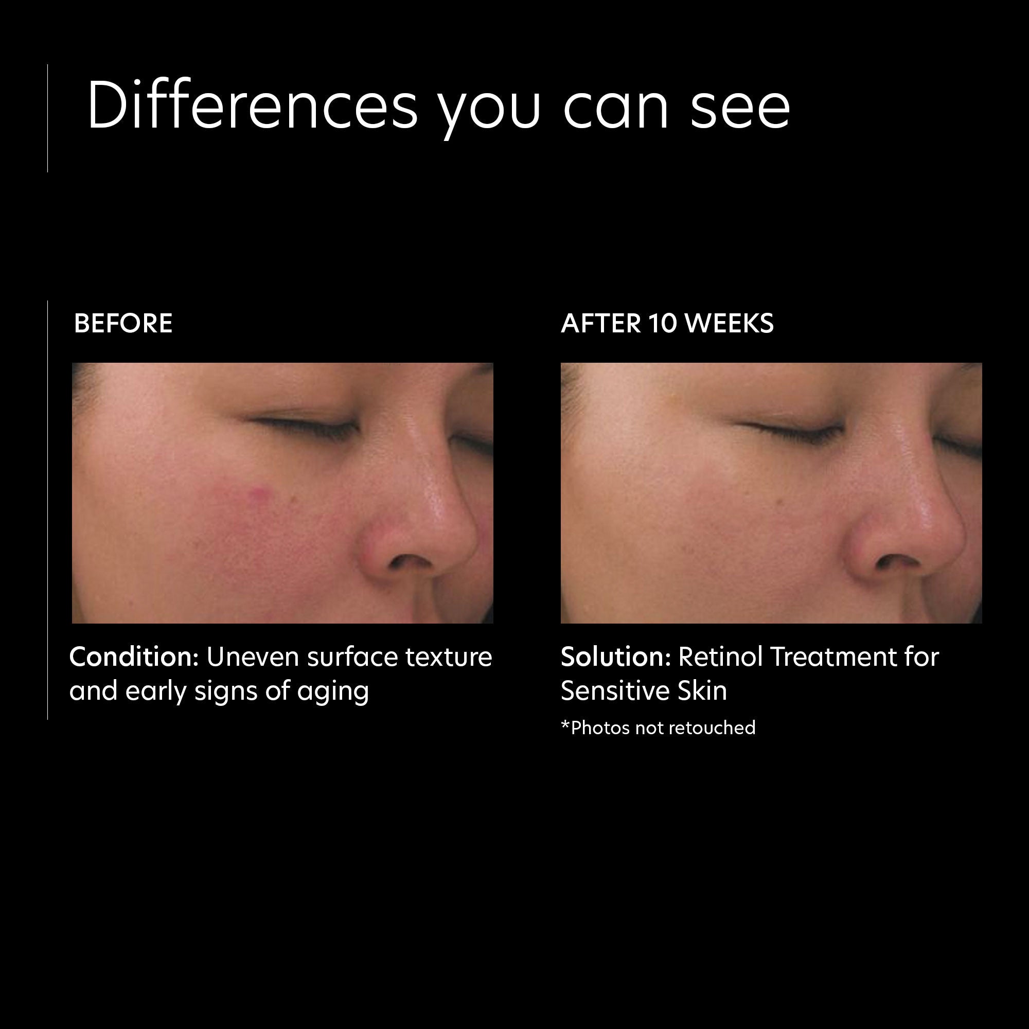 Retinol Treatment for Sensitive Skin