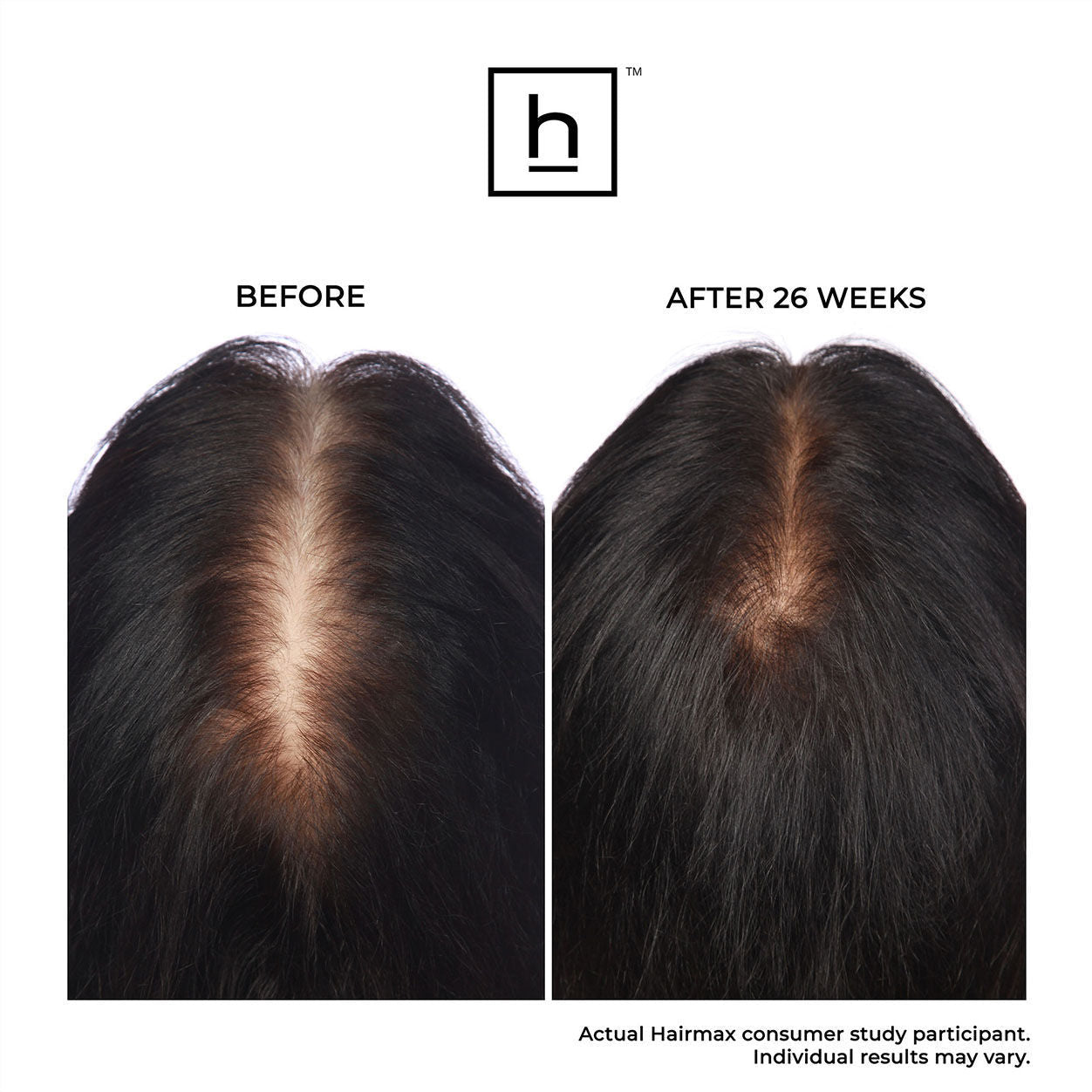 LaserBand 82 ComfortFlex