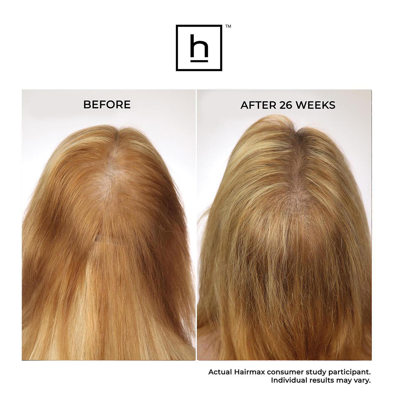 LaserBand 82 ComfortFlex