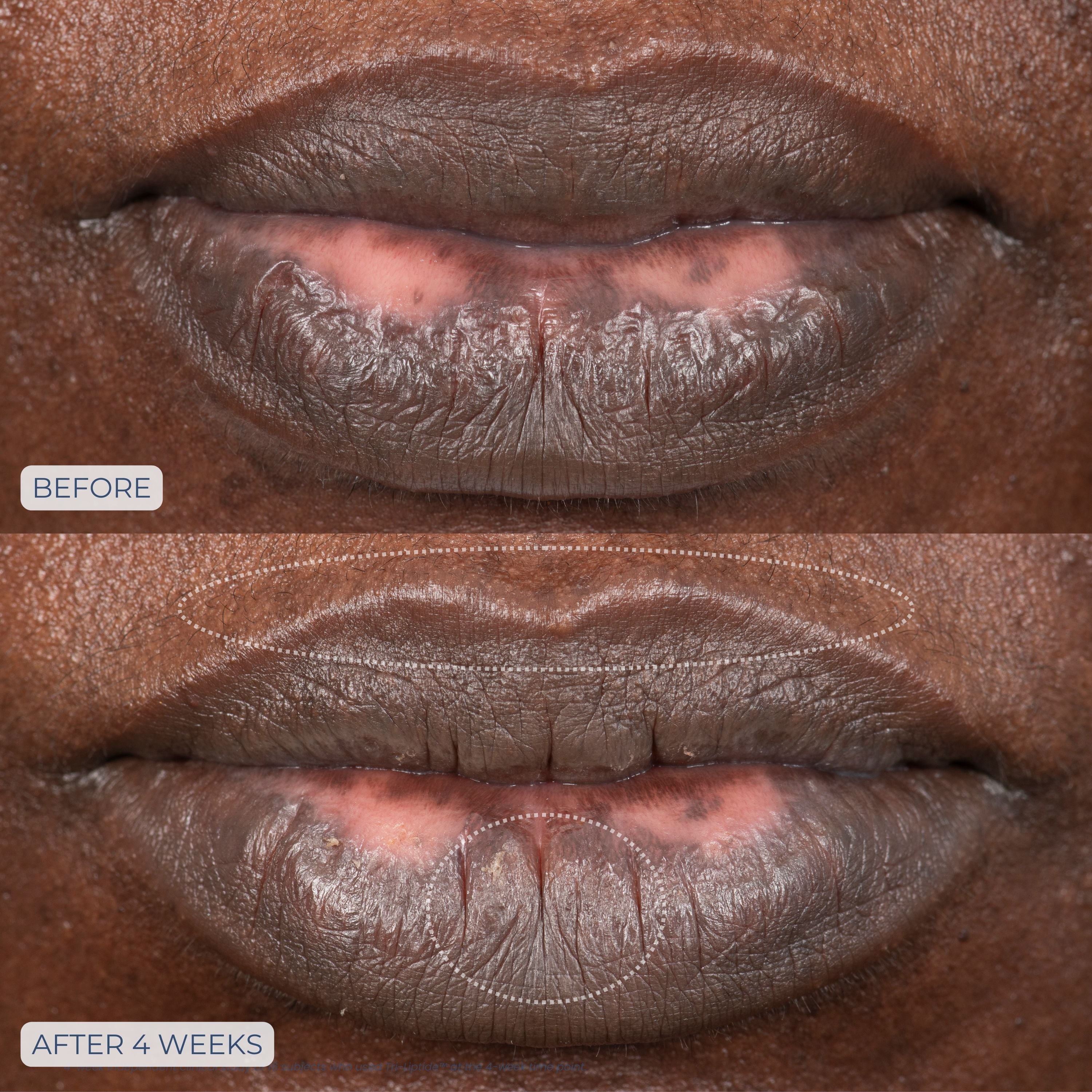 Tri-Liptide Peptide Lip Enhancing Treatment